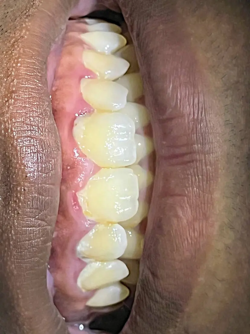 Dentadura después de limpieza dental profesional