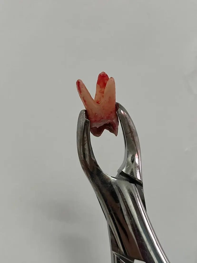 Diente extraído sostenido con fórceps dentales